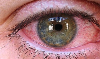 причины появления паразитов в глазах у человека